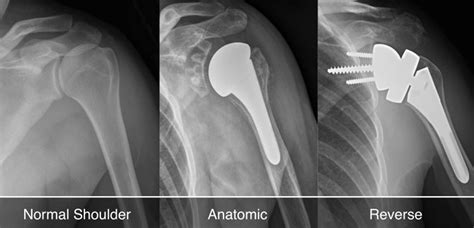 Total Shoulder Arthroplasty for Arthritis .